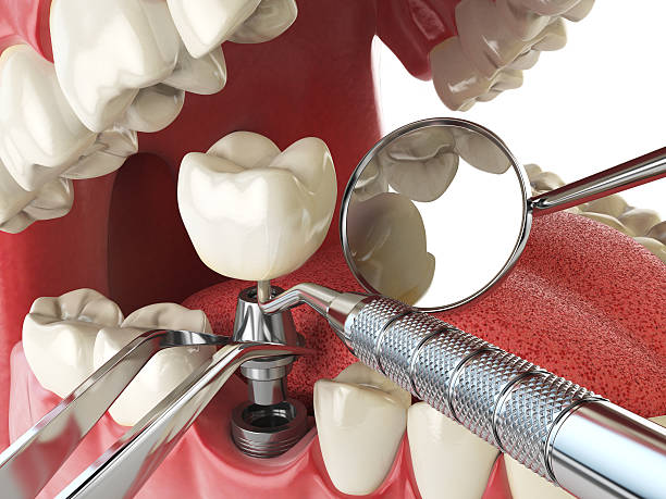 Best Emergency Tooth Extraction in Beulah, ND